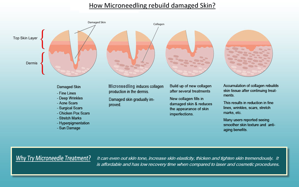 how does microneedling work